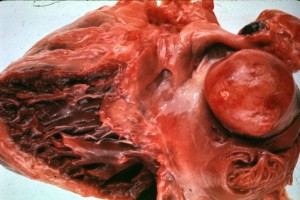 Cardiac Tumour1.jpg, 22.52 KB