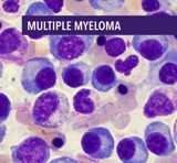 Multiple myeloma.jpg, 5.53 KB