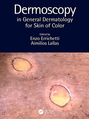 Dermoscopy in General Dermatology for Skin of Color.jpg, 27.72 KB